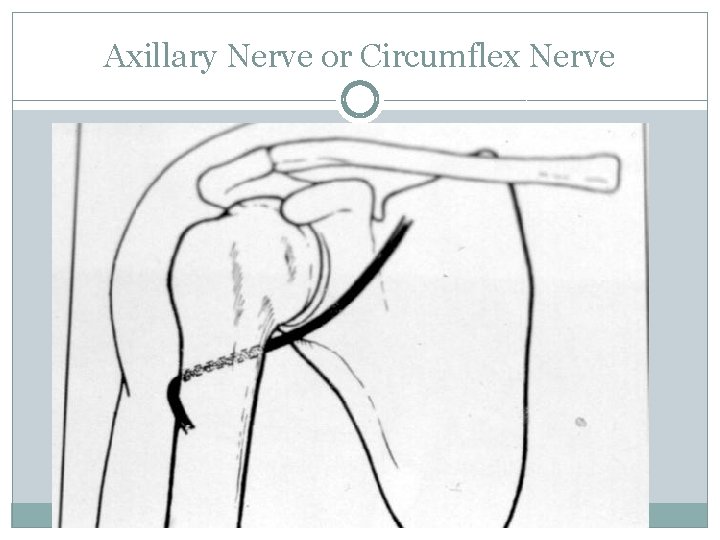 Axillary Nerve or Circumflex Nerve 