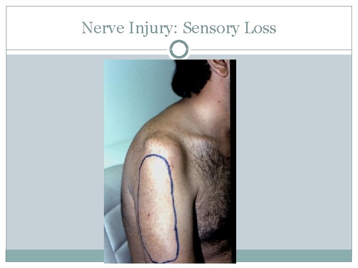 Nerve Injury: Sensory Loss 