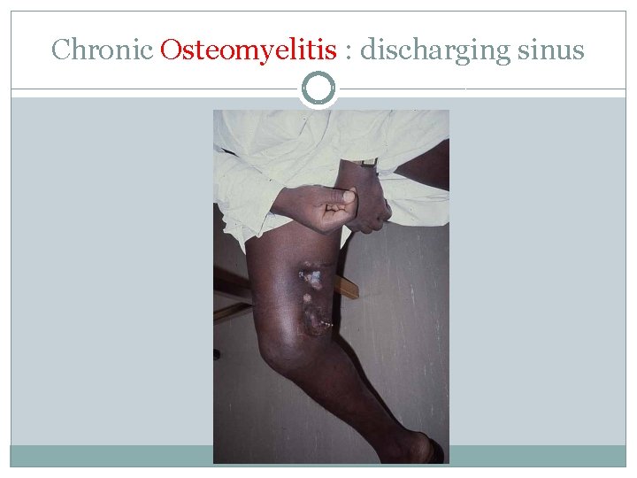 Chronic Osteomyelitis : discharging sinus 