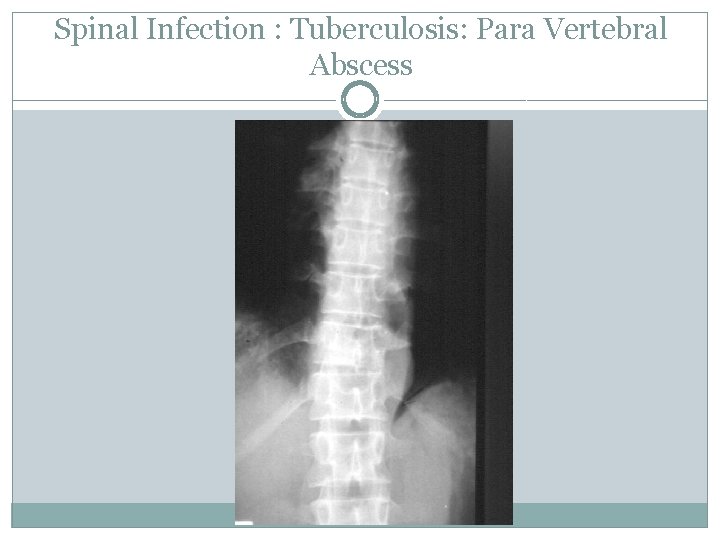 Spinal Infection : Tuberculosis: Para Vertebral Abscess 