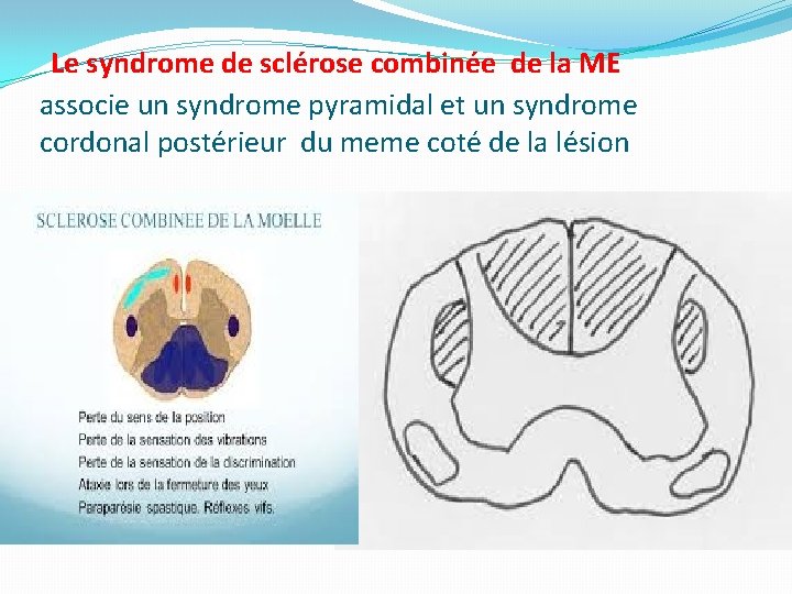 Le syndrome de sclérose combinée de la ME associe un syndrome pyramidal et un