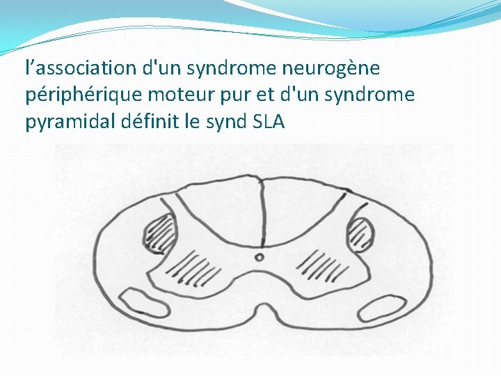 l’association d'un syndrome neurogène périphérique moteur pur et d'un syndrome pyramidal définit le synd