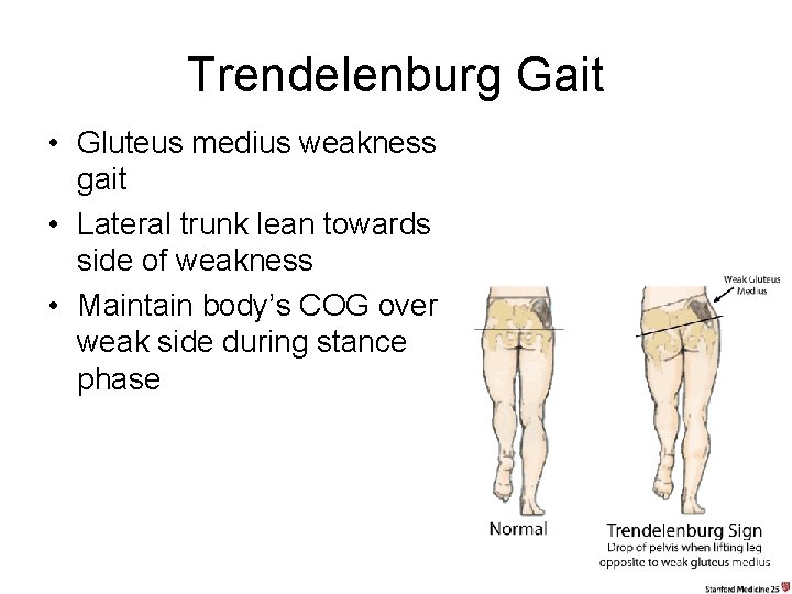 Trendelenburg Gait • Gluteus medius weakness gait • Lateral trunk lean towards side of