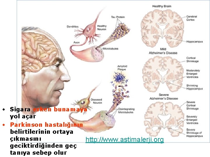 • Sigara erken bunamaya yol açar • Parkinson hastalığının belirtilerinin ortaya çıkmasını http: