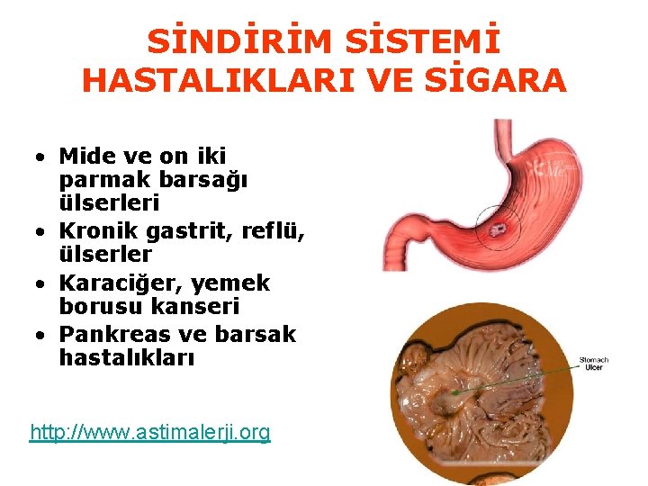 SİNDİRİM SİSTEMİ HASTALIKLARI VE SİGARA • Mide ve on iki parmak barsağı ülserleri •