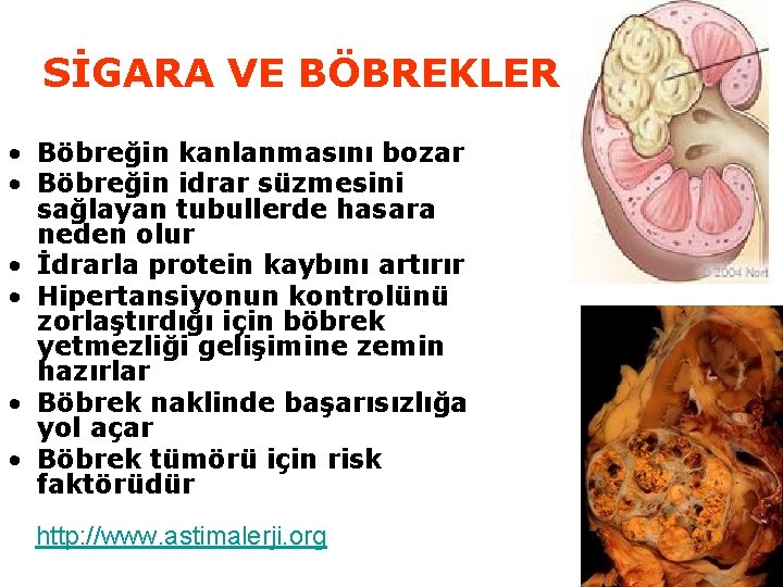 SİGARA VE BÖBREKLER • Böbreğin kanlanmasını bozar • Böbreğin idrar süzmesini sağlayan tubullerde hasara