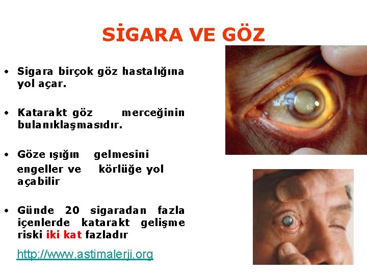 SİGARA VE GÖZ • Sigara birçok göz hastalığına yol açar. • Katarakt göz merceğinin