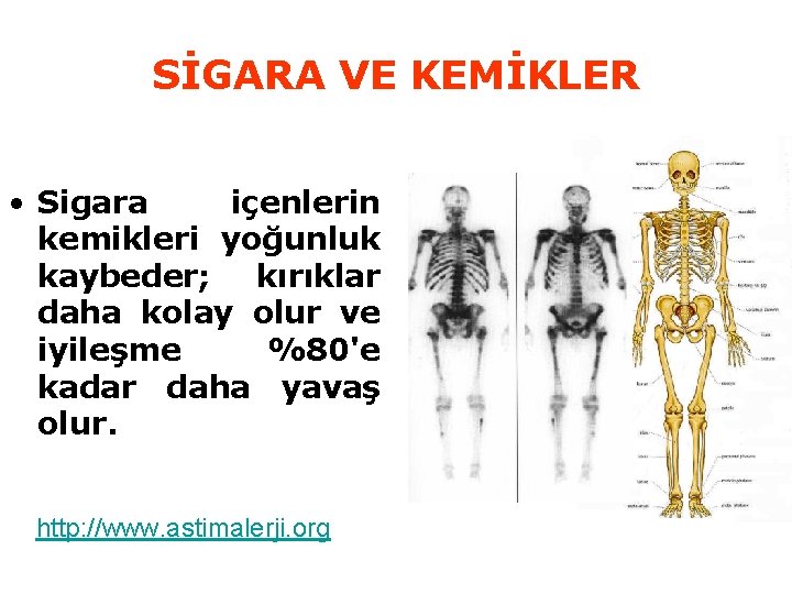 SİGARA VE KEMİKLER • Sigara içenlerin kemikleri yoğunluk kaybeder; kırıklar daha kolay olur ve