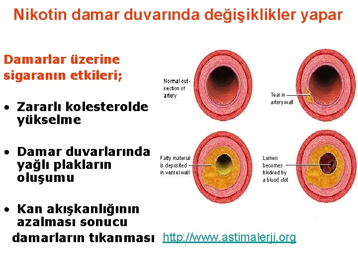 Nikotin damar duvarında değişiklikler yapar Damarlar üzerine sigaranın etkileri; • Zararlı kolesterolde yükselme •