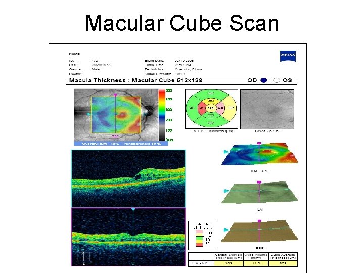 Macular Cube Scan 