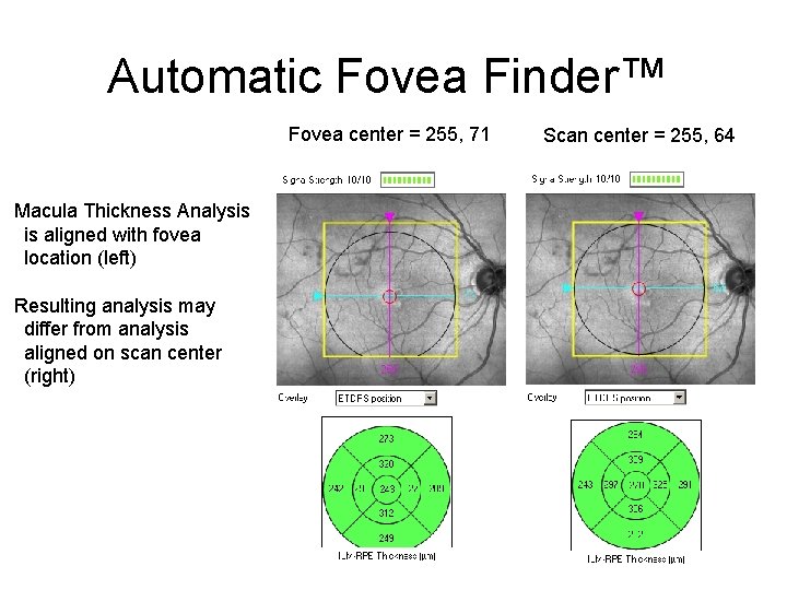 Automatic Fovea Finder™ Fovea center = 255, 71 Macula Thickness Analysis is aligned with