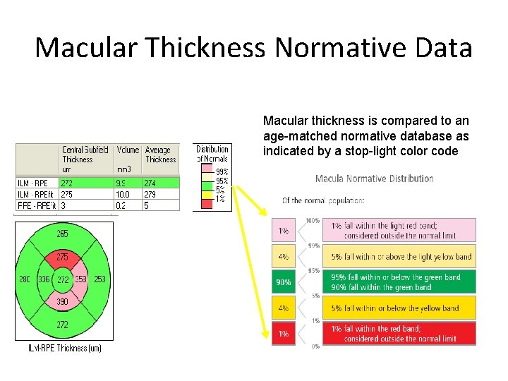Macular Thickness Normative Data Macular thickness is compared to an age-matched normative database as