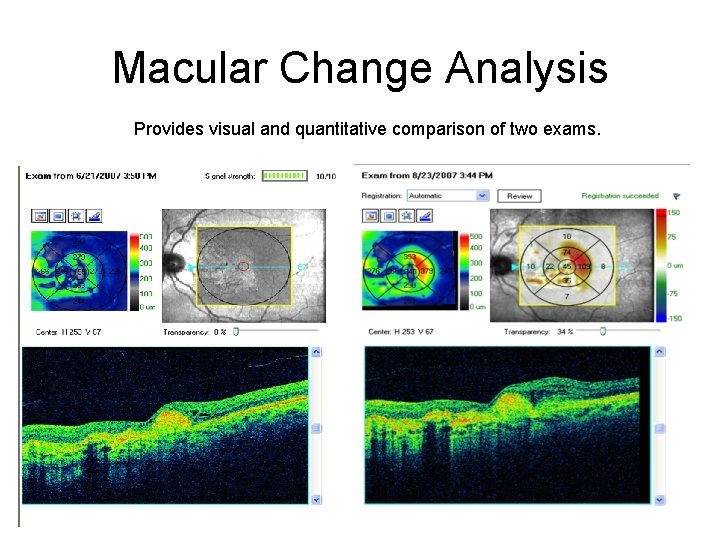 Macular Change Analysis Provides visual and quantitative comparison of two exams. 