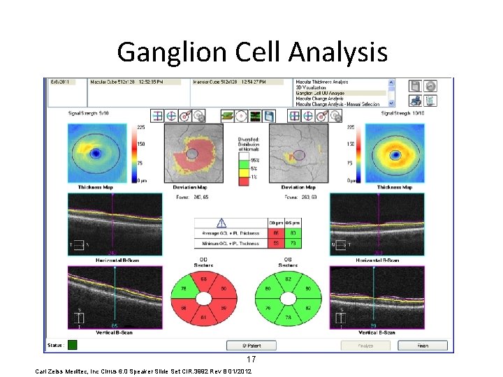 Ganglion Cell Analysis 17 Carl Zeiss Meditec, Inc Cirrus 6. 0 Speaker Slide Set