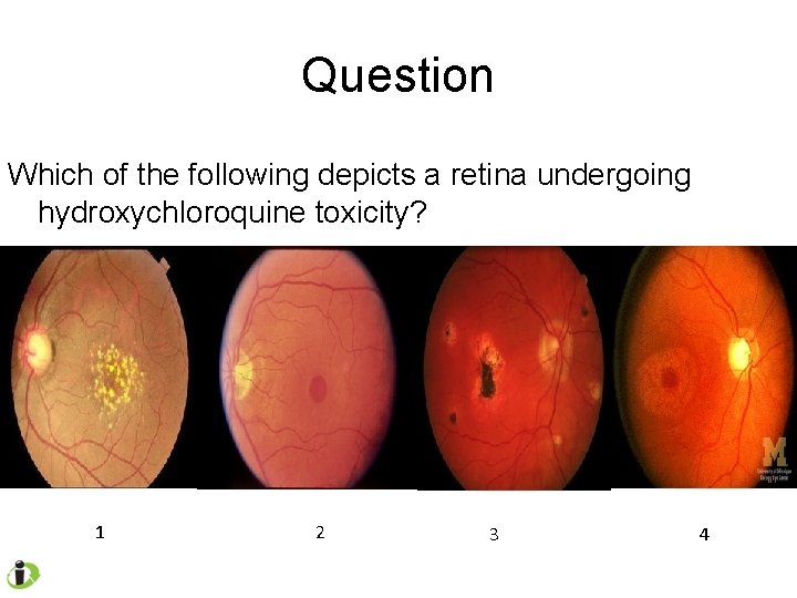 Question Which of the following depicts a retina undergoing hydroxychloroquine toxicity? 1 2 3