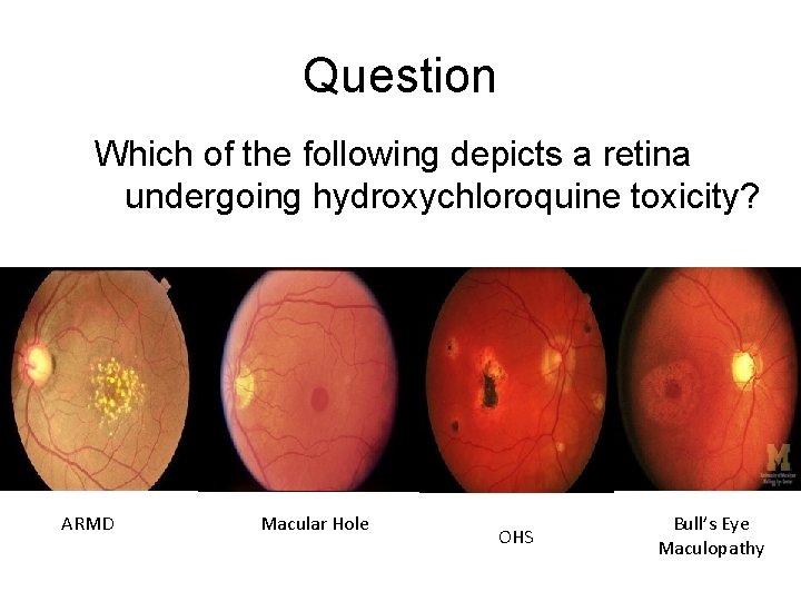 Question Which of the following depicts a retina undergoing hydroxychloroquine toxicity? ARMD Macular Hole