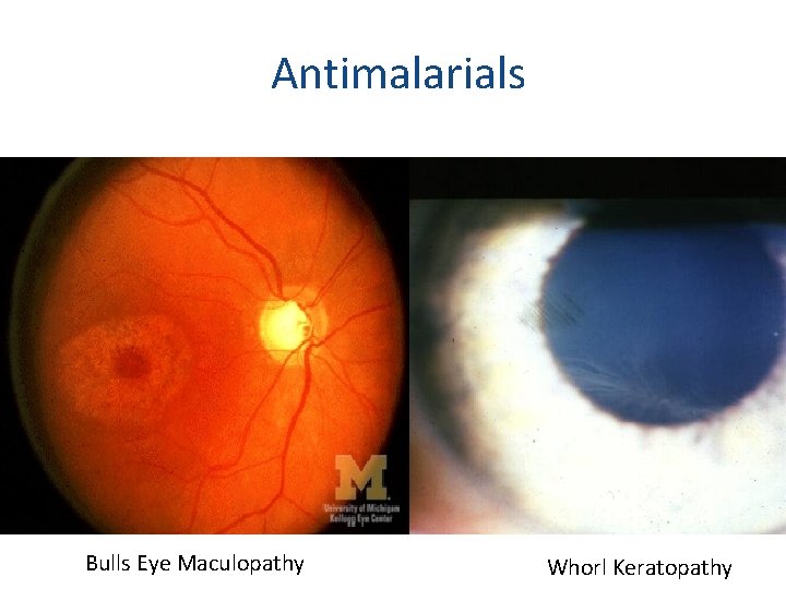 Antimalarials 29 Bulls Eye Maculopathy Whorl Keratopathy 