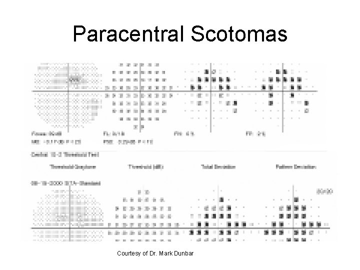 Paracentral Scotomas Courtesy of Dr. Mark Dunbar 