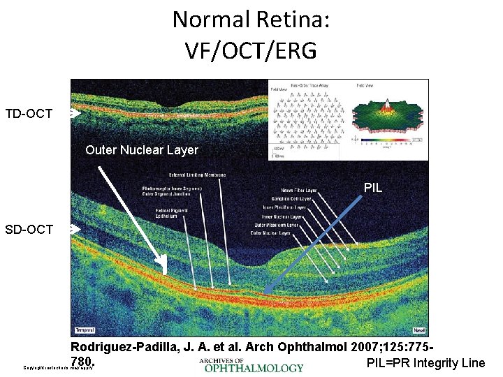 Normal Retina: VF/OCT/ERG TD-OCT Outer Nuclear Layer PIL SD-OCT Rodriguez-Padilla, J. A. et al.