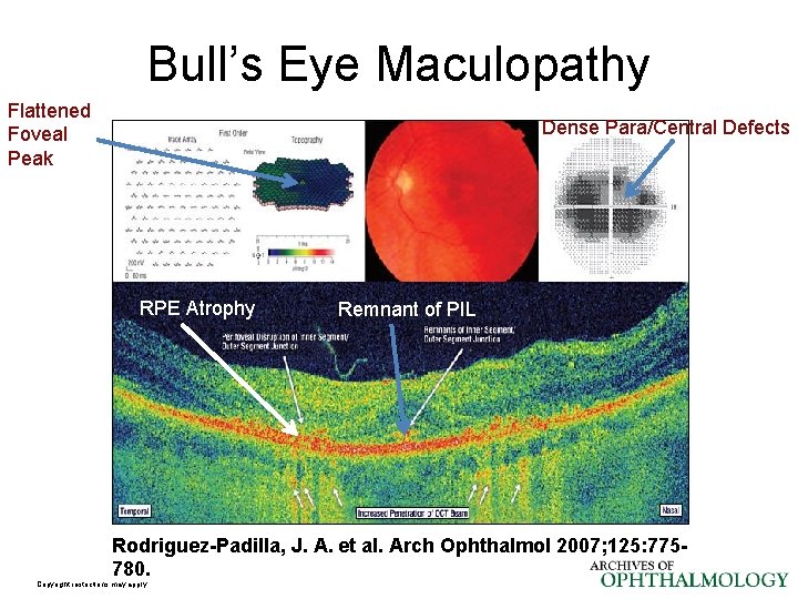 Bull’s Eye Maculopathy Flattened Foveal Peak Dense Para/Central Defects RPE Atrophy Remnant of PIL