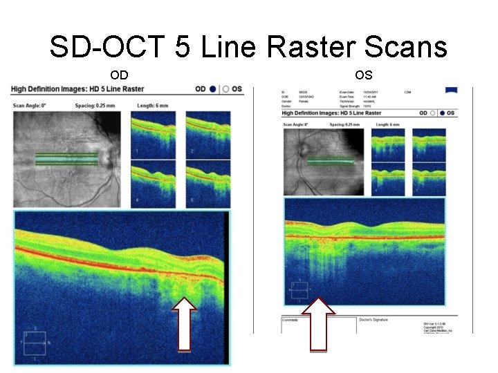 SD-OCT 5 Line Raster Scans OD OS 