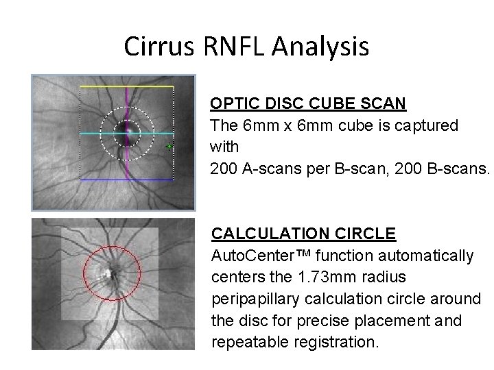 Cirrus RNFL Analysis OPTIC DISC CUBE SCAN The 6 mm x 6 mm cube