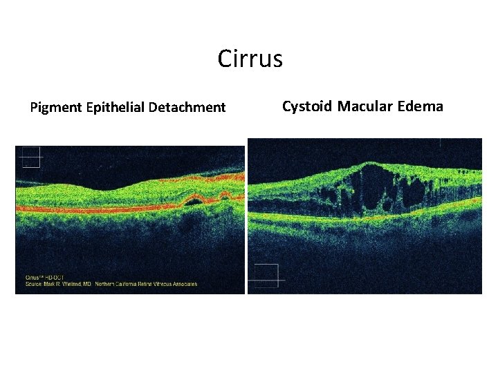 Cirrus Pigment Epithelial Detachment Cystoid Macular Edema 