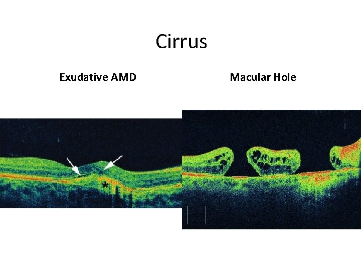 Cirrus Exudative AMD Macular Hole 