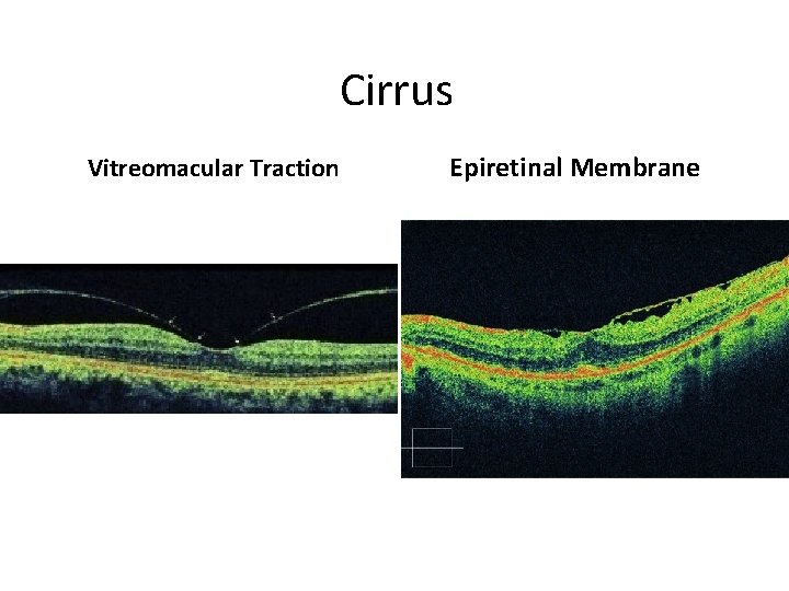 Cirrus Vitreomacular Traction Epiretinal Membrane 