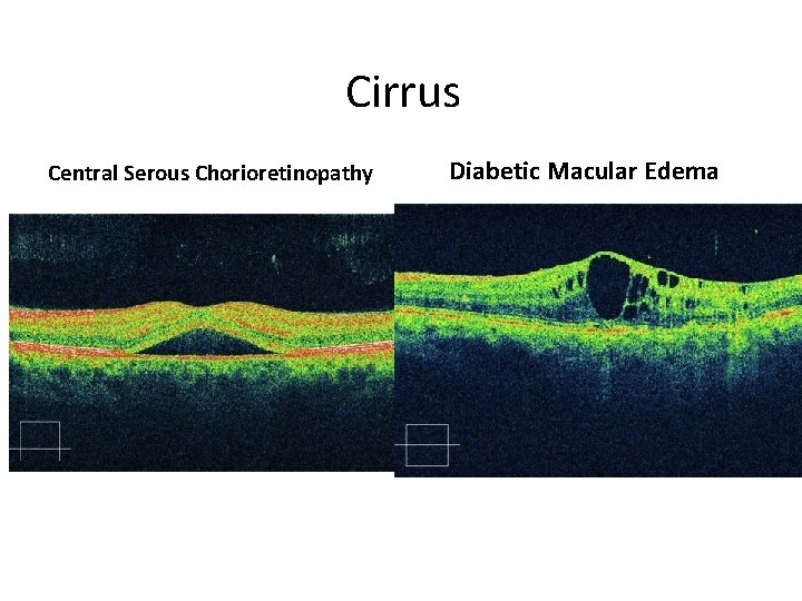 Cirrus Central Serous Chorioretinopathy Diabetic Macular Edema 