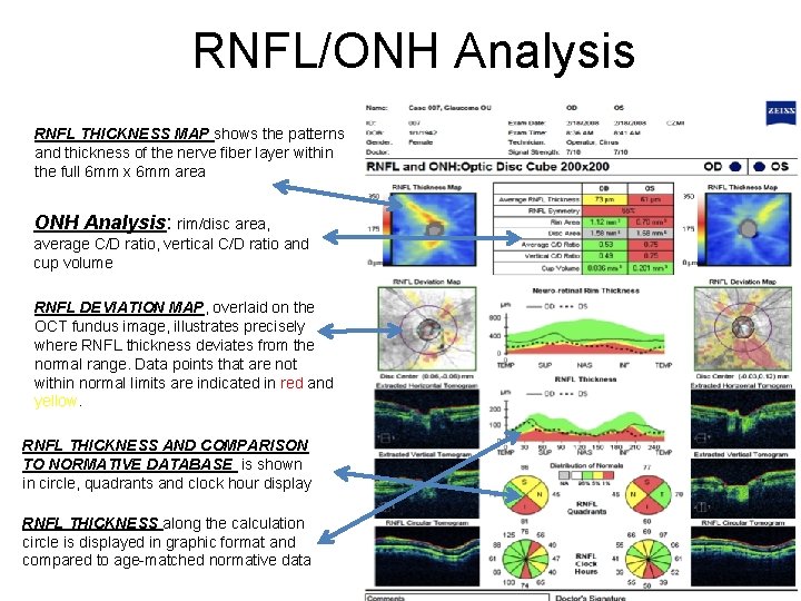 RNFL/ONH Analysis RNFL THICKNESS MAP shows the patterns and thickness of the nerve fiber