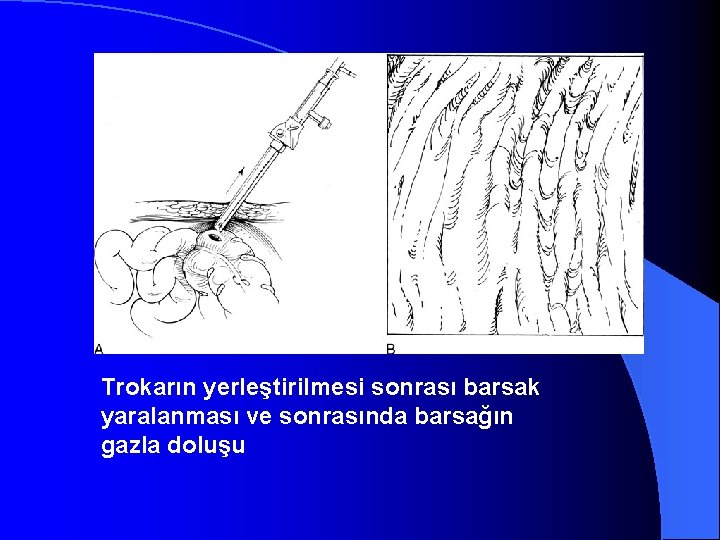 Trokarın yerleştirilmesi sonrası barsak yaralanması ve sonrasında barsağın gazla doluşu 