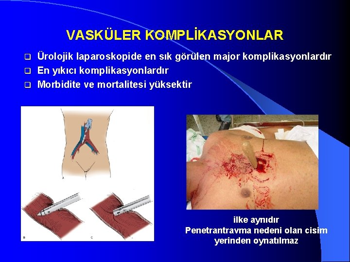 VASKÜLER KOMPLİKASYONLAR Ürolojik laparoskopide en sık görülen major komplikasyonlardır q En yıkıcı komplikasyonlardır q