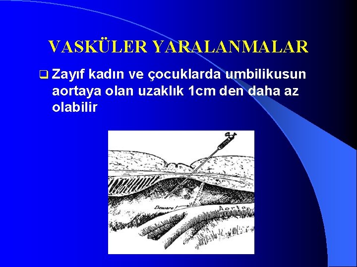 VASKÜLER YARALANMALAR q Zayıf kadın ve çocuklarda umbilikusun aortaya olan uzaklık 1 cm den