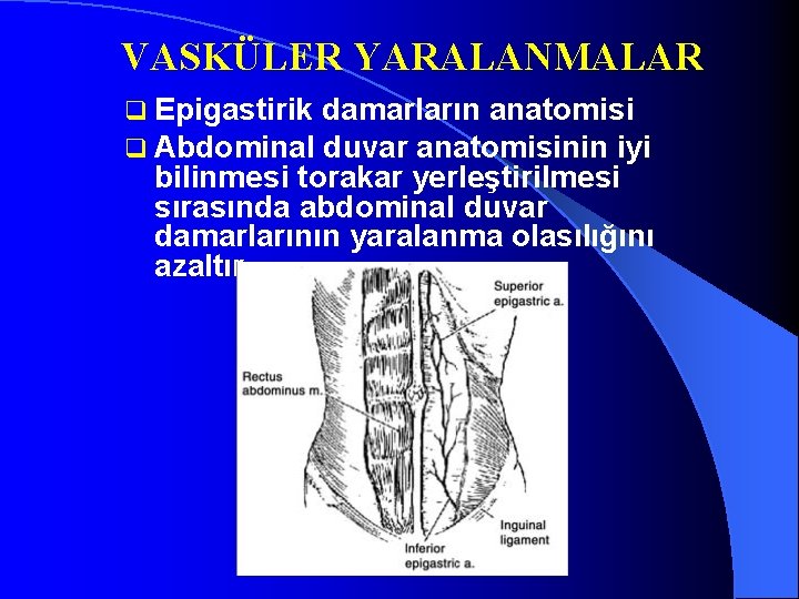 VASKÜLER YARALANMALAR q Epigastirik damarların anatomisi q Abdominal duvar anatomisinin iyi bilinmesi torakar yerleştirilmesi