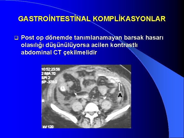 GASTROİNTESTİNAL KOMPLİKASYONLAR q Post op dönemde tanımlanamayan barsak hasarı olasılığı düşünülüyorsa acilen kontrastlı abdominal