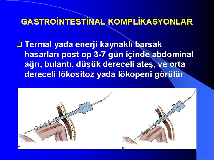 GASTROİNTESTİNAL KOMPLİKASYONLAR q Termal yada enerji kaynaklı barsak hasarları post op 3 -7 gün