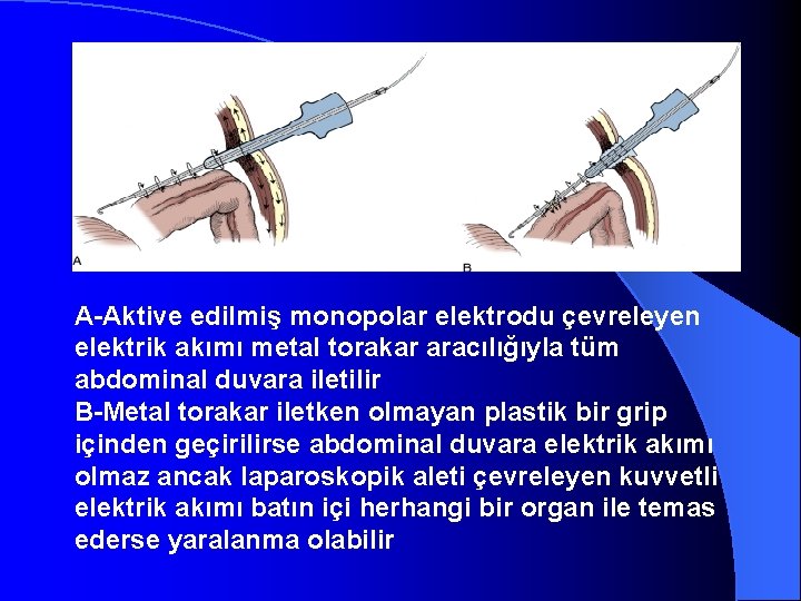 A-Aktive edilmiş monopolar elektrodu çevreleyen elektrik akımı metal torakar aracılığıyla tüm abdominal duvara iletilir