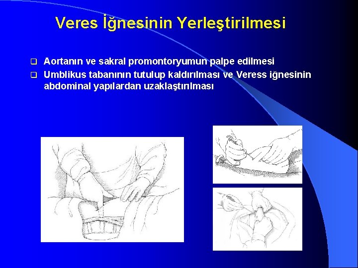 Veres İğnesinin Yerleştirilmesi Aortanın ve sakral promontoryumun palpe edilmesi q Umblikus tabanının tutulup kaldırılması