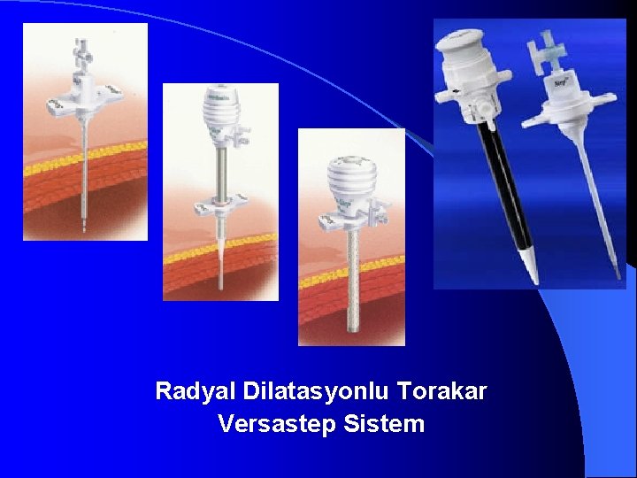 Radyal Dilatasyonlu Torakar Versastep Sistem 