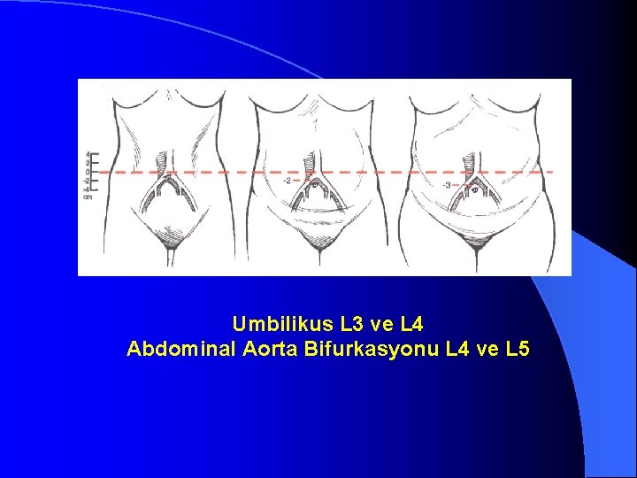Umbilikus L 3 ve L 4 Abdominal Aorta Bifurkasyonu L 4 ve L 5