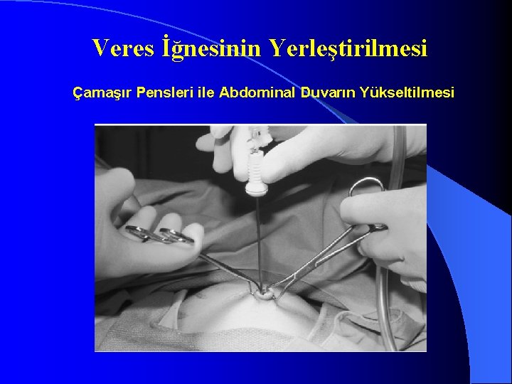 Veres İğnesinin Yerleştirilmesi Çamaşır Pensleri ile Abdominal Duvarın Yükseltilmesi 