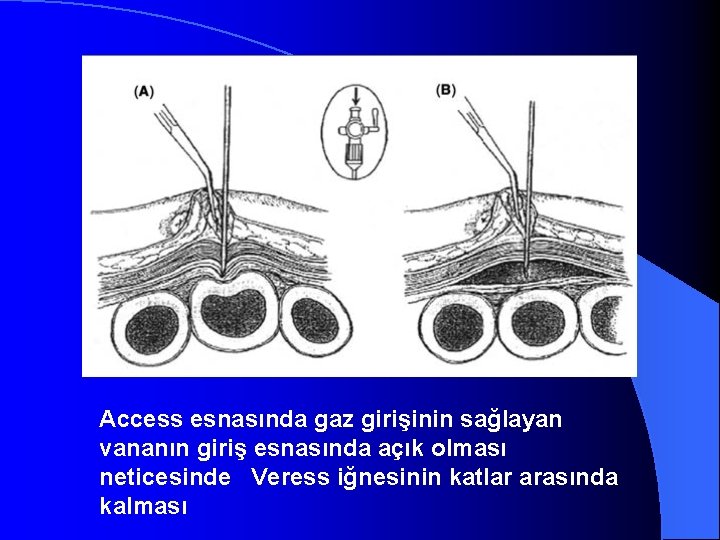 Access esnasında gaz girişinin sağlayan vananın giriş esnasında açık olması neticesinde Veress iğnesinin katlar