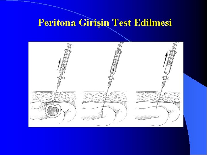 Peritona Girişin Test Edilmesi 