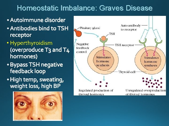 Homeostatic Imbalance: Graves Disease • Hyperthyroidism 