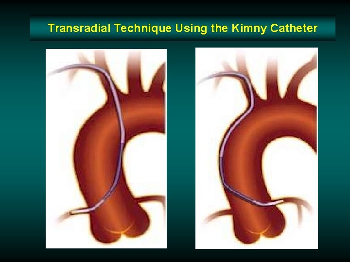 Transradial Technique Using the Kimny Catheter Transradial Technique Using the Kimny Catheter
