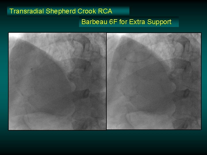 Transradial Shepherd Crook RCA Barbeau 6 F for Extra Support Transradial Shepherd Crook RCA Barbeau 6 F for Extra Support