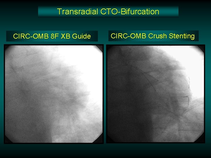 Transradial CTO-Bifurcation CIRC-OMB 8 F XB Guide CIRC-OMB Crush Stenting Transradial CTO-Bifurcation CIRC-OMB 8 F XB Guide CIRC-OMB Crush Stenting