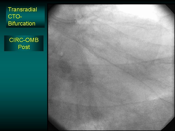 Transradial CTOBifurcation CIRC-OMB Post Transradial CTOBifurcation CIRC-OMB Post