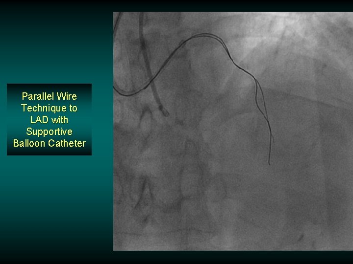 Parallel Wire Technique to LAD with Supportive Balloon Catheter Parallel Wire Technique to LAD with Supportive Balloon Catheter